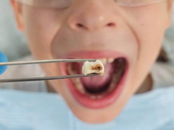 Best Emergency Treatment for Toothache in Hondo, TX